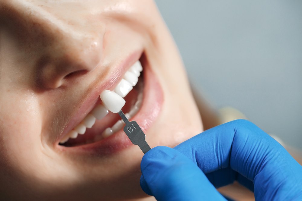 Enhance Your Smile with Dental Veneers in Fayetteville, AR - Tipsearth.com