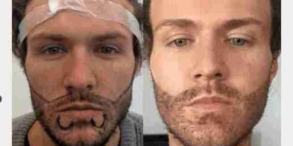 Facial Hair Transplant Cost: Your Ultimate Guide