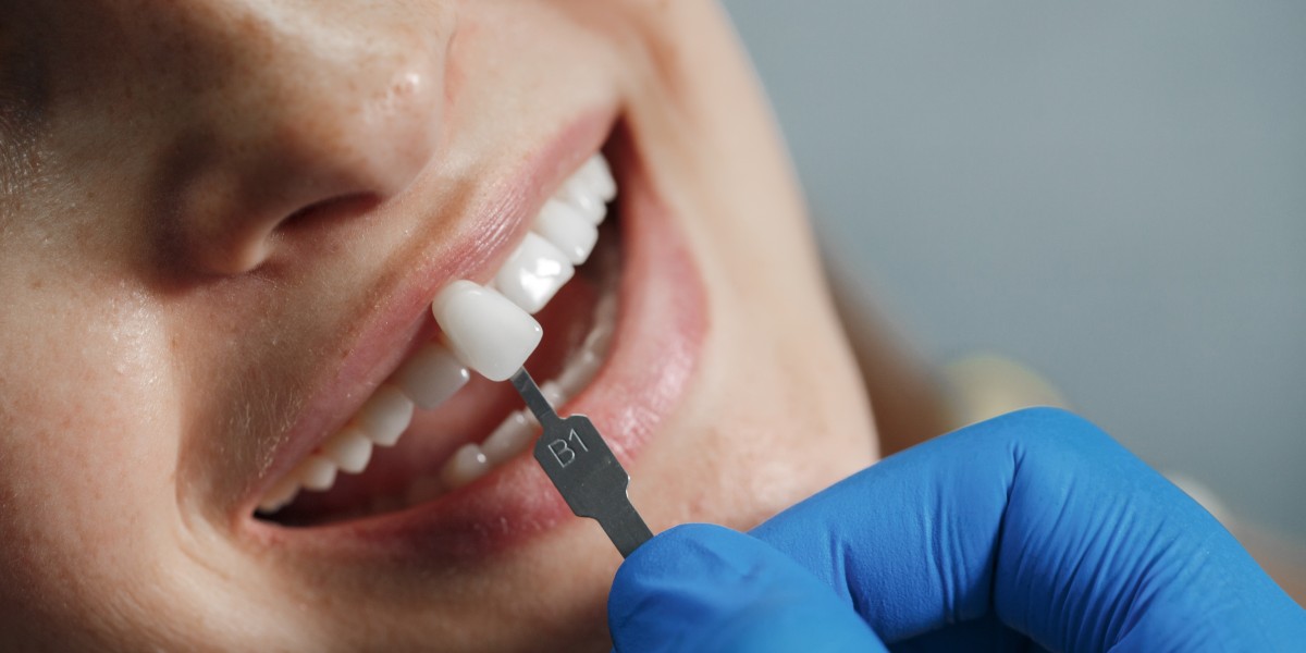 Dental Excellence in Teddington: The Essential Role of Implants and Hygiene in Lasting Oral Health