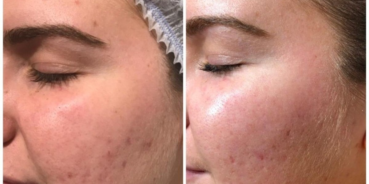Microneedling London: The Collagen-Boosting Secret to Youthful, Radiant Skin