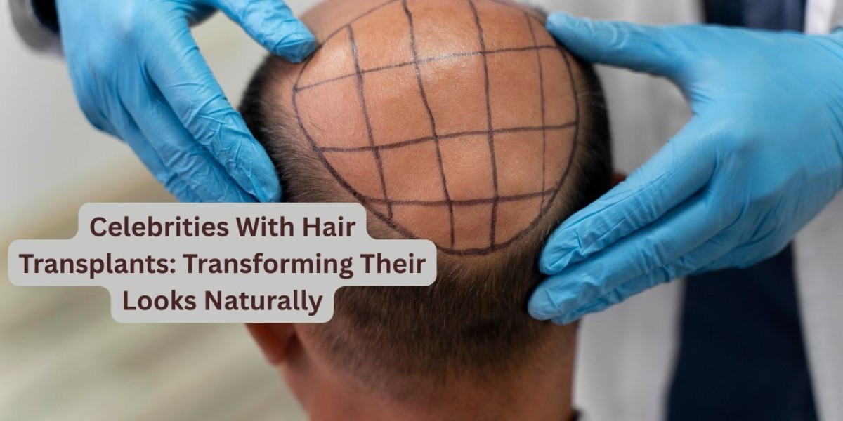Celebrities With Hair Transplants: Transforming Their Looks Naturally