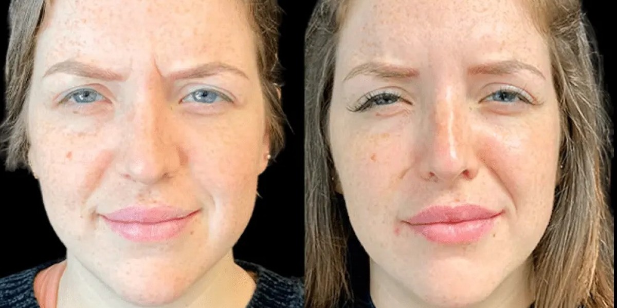 Best Plastic Surgeon in dubai for Botox Forehead & Frown Lines