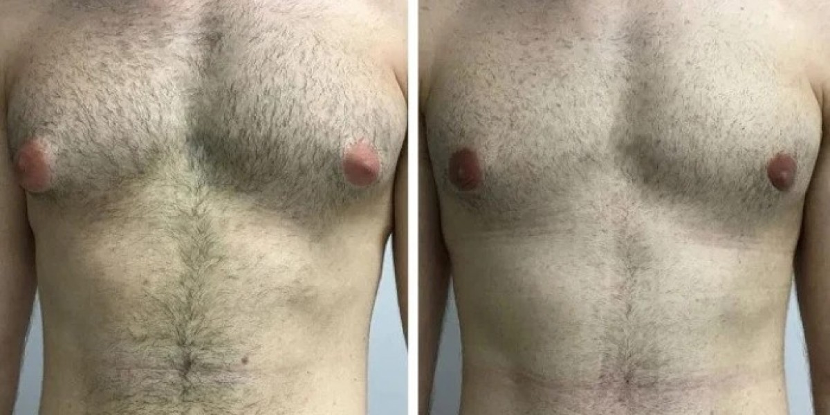 Gynecomastia Surgery in Dubai: Recovery Expectations in a Busy Lifestyle