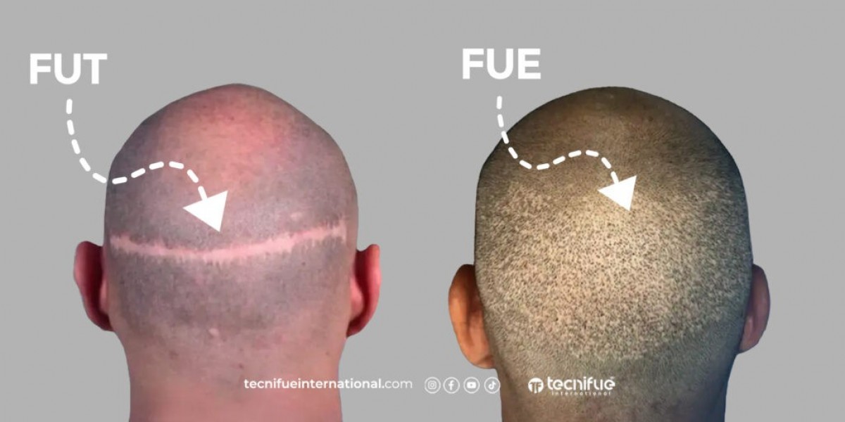Best Hair Transplant Turkey: Complete Guide to Donor Area Management